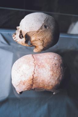 Elongated skull from Malta